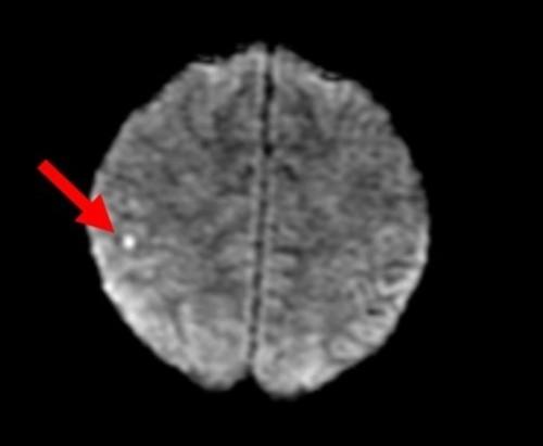 Acute Cerebrovascular Accident, Renal Failure, and Thrombotic Microangiopathy in a 27-Year-Old Male With Malignant Hypertension