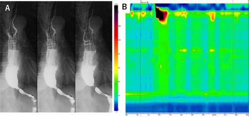 Concurrent Diagnosis of Superficial Esophageal Cancer and Esophageal Achalasia: A Case Report and Literature Review