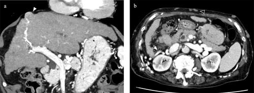 Thoracoscopic Transthoracic Hepatectomy for Hepatocellular Carcinoma in Budd-Chiari Syndrome