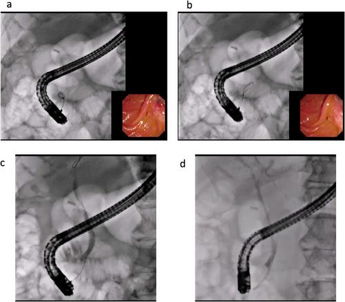Japanese Multi-Institution Study of Success Rates of Wire-Guided Biliary Cannulation During Endoscopic Retrograde Cholangiopancreatography in Relation to Guidewire tip Length (With Video)