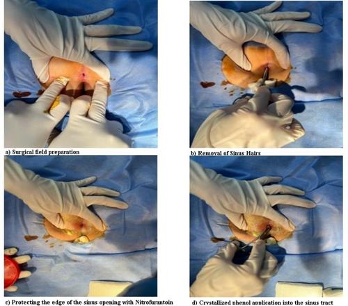 Our Experience With Four or More Crystallised Phenol Applications in Pilonidal Sinus Disease