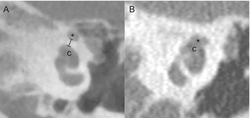 Prevalence of Cochlear-Facial Nerve Dehiscence and Facial Nerve Stimulation for Adult Cochlear Implant Recipients