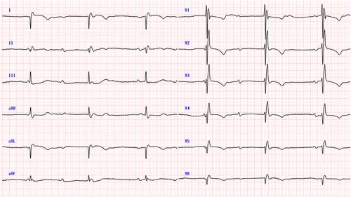 Successful pacemaker implantation using left bundle branch area pacing in a patient with dextrocardia: A case report