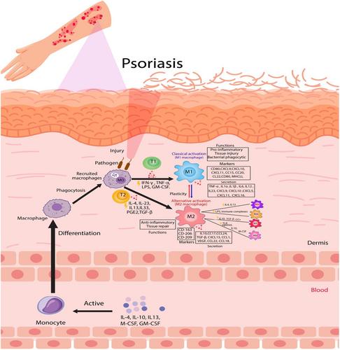 The M2 Macrophages Importance Role in Psoriasis