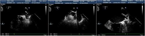Role of Transesophageal Echocardiography in Guiding and Evaluating Left Atrial Appendage Occlusion in Patients With Non-Organic Heart Disease