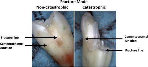 The Influence of Deep Margin Elevation and Immediate Dentin Sealing on the Fracture Strength of Premolars Restored With Indirect Inlays: An In Vitro Study