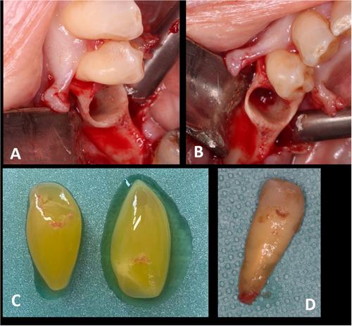 Endodontic Consequences of Early Stage of Medication-Related Osteonecrosis of the Jaw: A Case Report