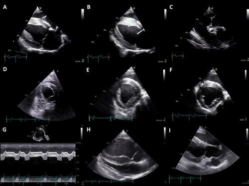 Evaluation of Subjective Assessment of Right Heart Size and Function Using Standard 2D-Echocardiographic Recordings in Horses With and Without Pulmonary Hypertension