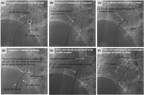 Successful left atrial access through GORE CARDIOFORM ASD occluder using an integrated transseptal wire system after failed RF needle approach