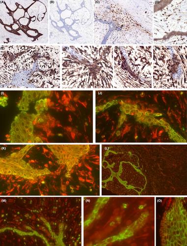 Epithelial elements in superficial angiomyxomas: mimicry of adnexal development, and mesenchymal-to-epithelial transition