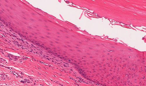 Subungual Epidermoid Inclusions–A Series of 8 Cases and a Review of Literature