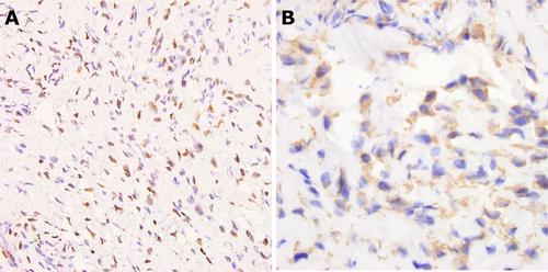 Unusual Morphologic Presentation of Perineural Spread From Cutaneous Squamous Cell Carcinoma: Diagnosis Aided by Comprehensive Molecular Analysis and Machine Learning