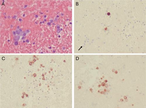 Cytological Assessment of Metastatic Gastrointestinal Stromal Tumor in Ascitic Fluid