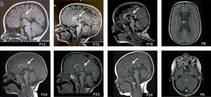 Comprehensive analysis of CNOT3-related neurodevelopmental disorders: phenotypic and genotypic characterization