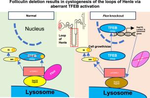 Folliculin Deletion in the Mouse Kidney Results in Cystogenesis of the Loops of Henle via Aberrant TFEB Activation