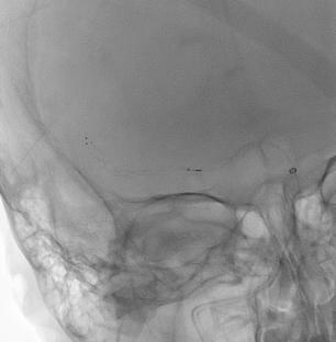 Successful transcirculation thrombectomy through the posterior communicating artery for acute MCA occlusion: a case report