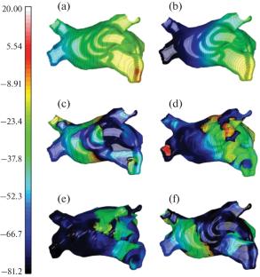 Patient-Centered Computer Model Comparing Excitation Conduction in Normal and Long-Term Persistence of Atrial Fibrillation
