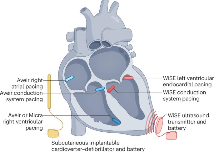 Leadless and extravascular cardiac resynchronization therapy: the future for CRT?