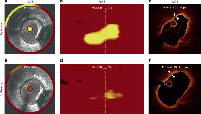 The sequence of changes in intravascular imaging findings during lipid-lowering therapy and its implication