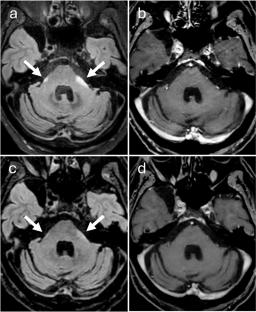 Atypical presentation of leptomeningeal disease in lung adenocarcinoma: the bloomy rind sign