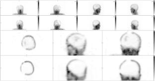 From planar to SPECT-CT brain perfusion study in brain death determination: our experience from 2010 to 2023