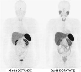 Comparison of radiolabeled somatostatin analogs (DOTATATE, DOTANOC, and DOTATOC) in somatostatin receptor (SSTR) imaging for gastroenteropancreatic neuroendocrine neoplasms (GEP-NENs): a narrative literature review