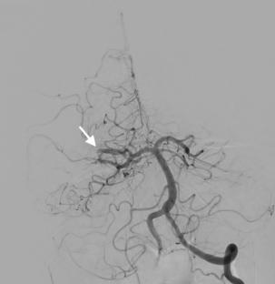 Successful transcirculation thrombectomy through the posterior communicating artery for acute MCA occlusion: a case report