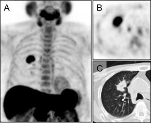 Prognostic value of pre-treatment metabolic tumor volume on [S‑methyl‑11C]‑L‑methionine PET/CT in patients with local non-small cell lung carcinoma treated with single-fraction carbon-ion radiotherapy