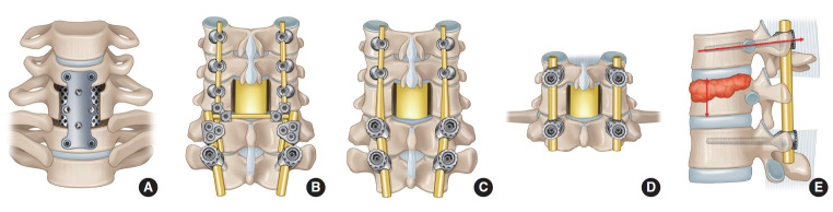 Anterior Corpectomy Versus Posterior Pedicle Screw Fixation With 5.5-mm Rods for Metastatic Spinal Tumor Located in the Cervicothoracic Junction.