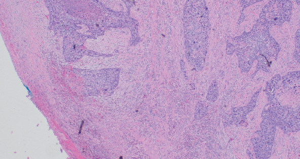 Primary Squamous Cell Carcinoma of the Uterus and Not the Cervix-A Case Report and Literature Review.
