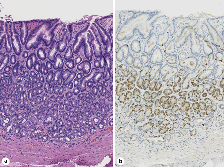 Diarrhea, Weight Loss, and an Elevated Gastrin: A Case Report.