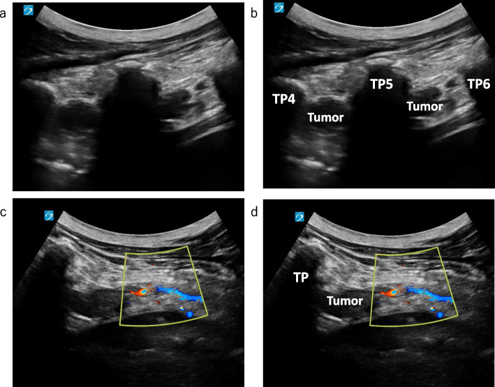 What is safe paravertebral block and neuraxial anesthesia for patients with neurofibromatosis type 1?