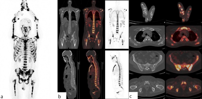 <sup>68</sup>Ga-PENTIXAFOR PET/CT Captures Superscan in Refractory Multiple Myeloma.