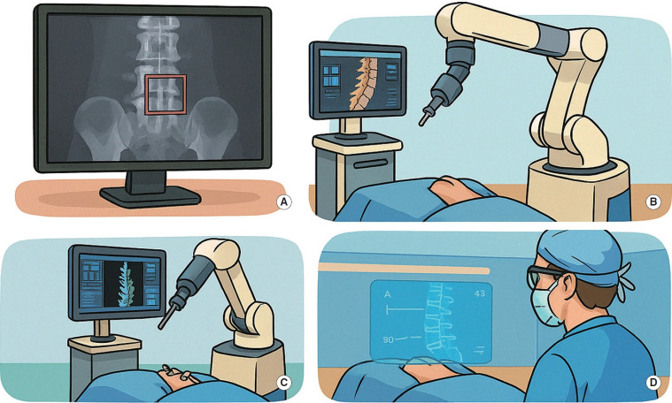 Artificial Intelligence (AI) Agents Versus Agentic AI: What's the Effect in Spine Surgery?