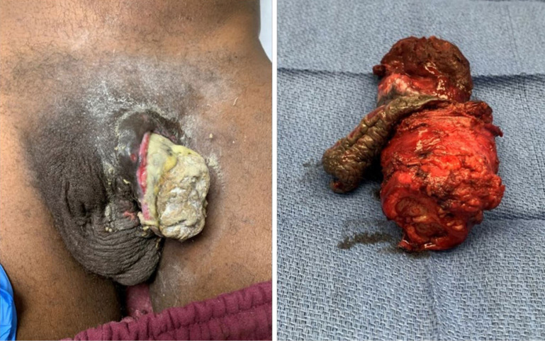 Penile calciphylaxis: surgical management in the setting of Fournier's gangrene-a case report and literature review.