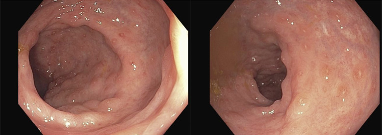 Curcumin-QingDai Combination as Treatment for Crohn's Disease: A Case Report.