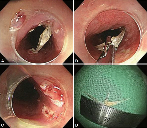 Two Cases of Pneumothorax Induced by Fish Bones Impacted in the Esophagus.