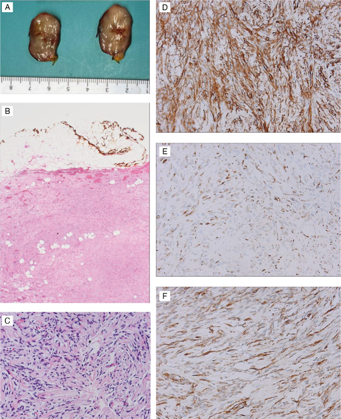Breast Myofibroblastoma: A Single Institutional Case Series.