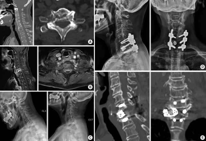 Anterior Corpectomy Versus Posterior Pedicle Screw Fixation With 5.5-mm Rods for Metastatic Spinal Tumor Located in the Cervicothoracic Junction.