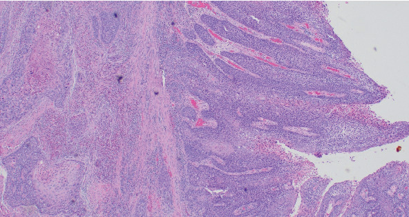 Primary Squamous Cell Carcinoma of the Uterus and Not the Cervix-A Case Report and Literature Review.