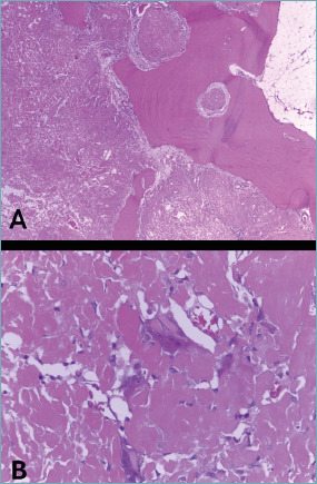 Histological and proteomic characterization of musculoskeletal amyloidomas.