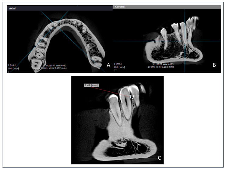 Voxel Size and Field of View Influence on Periodontal Bone Assessment Using Four CBCT Systems: An Experimental Ex Vivo Analysis.