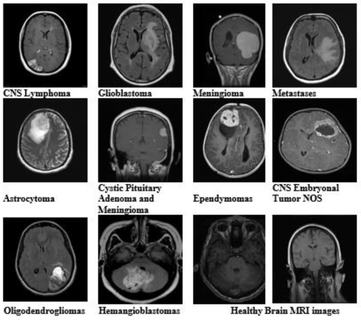 Corrigendum: An enhanced pattern detection and segmentation of brain tumors in MRI images using deep learning technique.