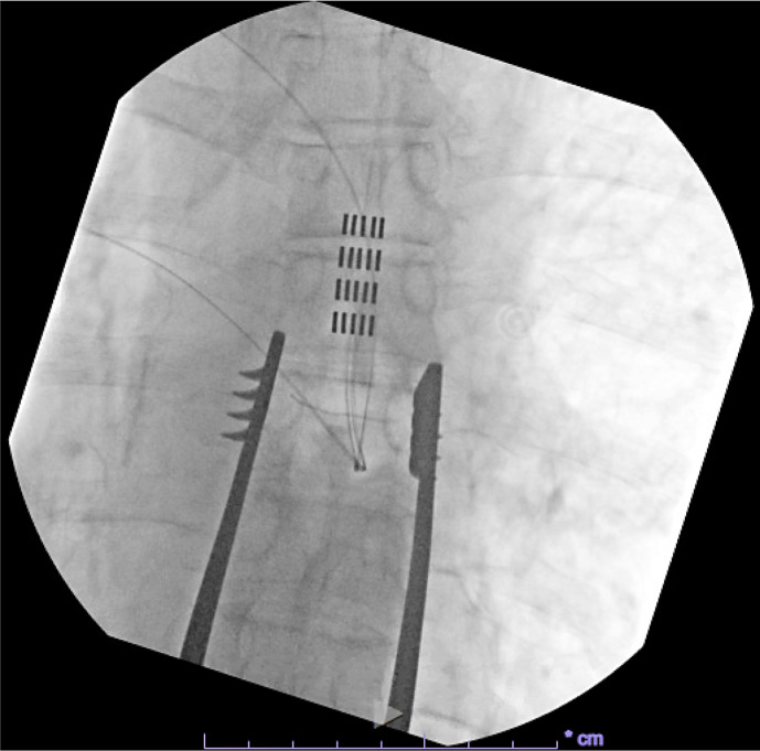 Spinal Cord Stimulation for Diffuse Visceral Hyperalgesia in the Abdomen: A Case Report and Literature Review.