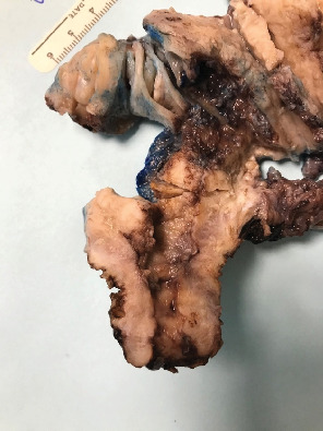 Primary Squamous Cell Carcinoma of the Uterus and Not the Cervix-A Case Report and Literature Review.