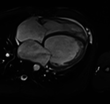 Dilated Cardiomyopathy in a Young Patient With an <i>FLNC</i> Gene Mutation.