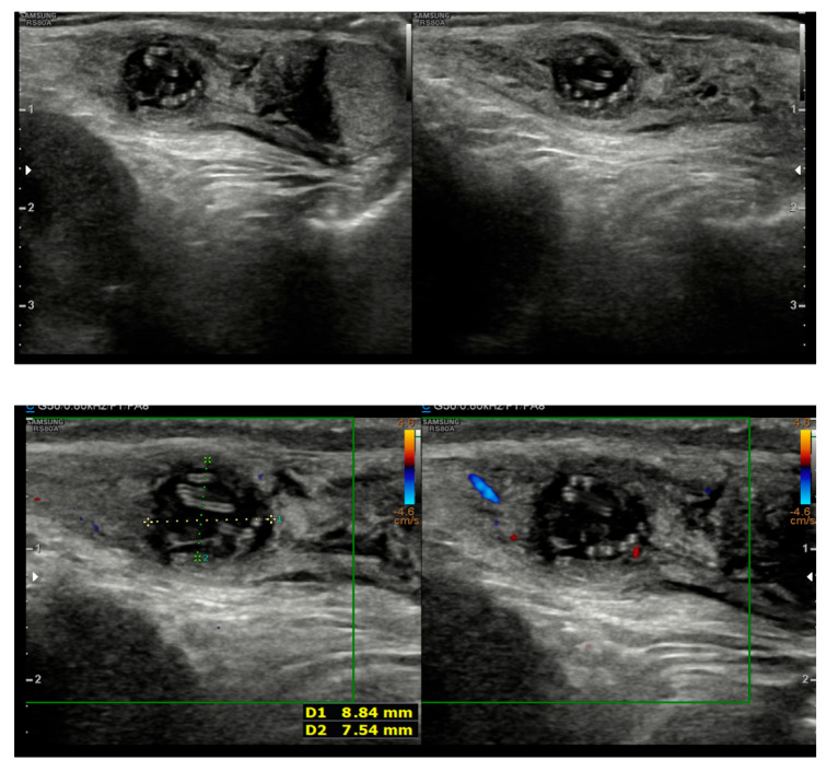 <i>Dirofilaria repens</i> in the Spermatic Cord of a 5-Year-Old Boy: A Rare Pediatric Case in Italy.