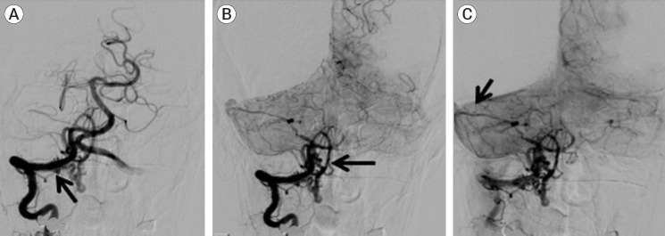 Endovascular flow diversion treatment of spontaneous craniocervical junction vertebral artery dural fistula and literature review.