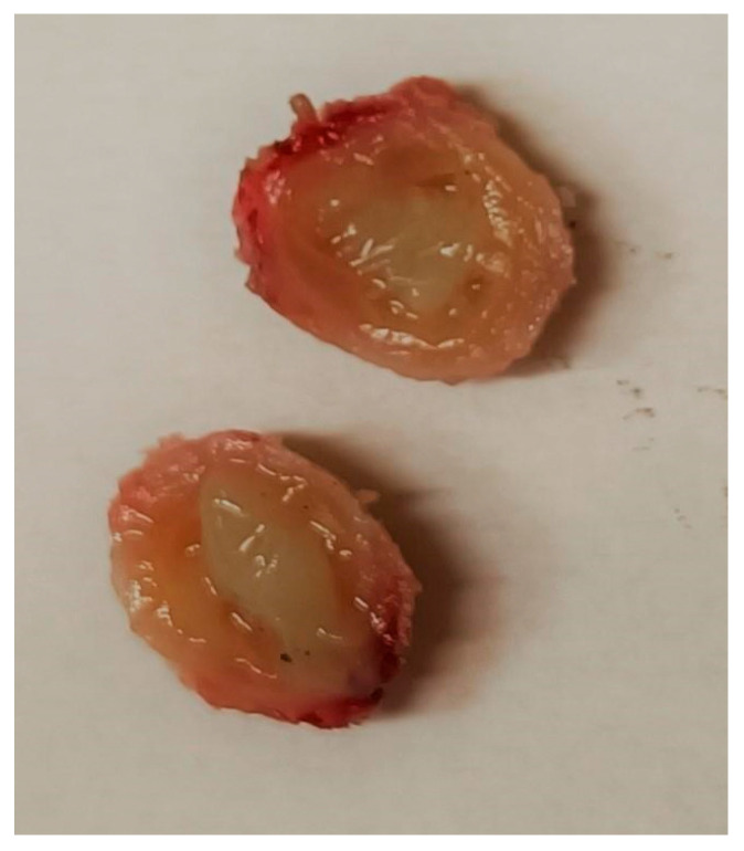 <i>Dirofilaria repens</i> in the Spermatic Cord of a 5-Year-Old Boy: A Rare Pediatric Case in Italy.
