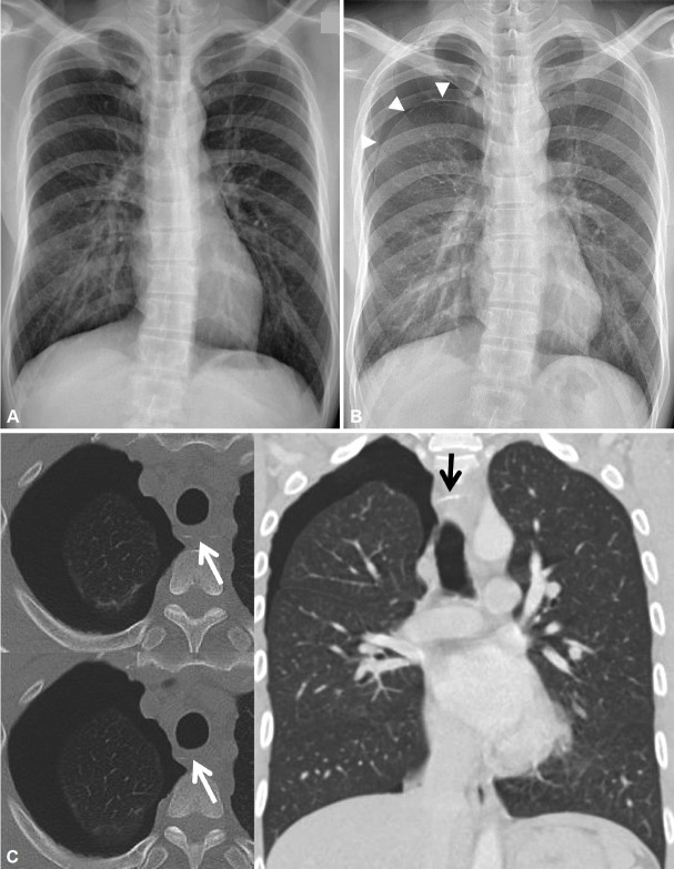 Two Cases of Pneumothorax Induced by Fish Bones Impacted in the Esophagus.